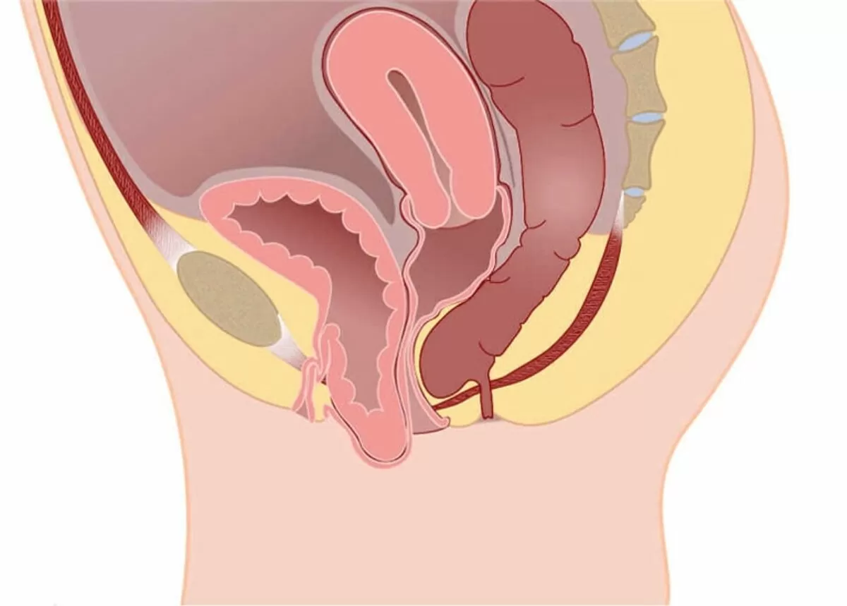 Ameliyatsız Rahim Sarkması Tedavisi Mümkün mü?
