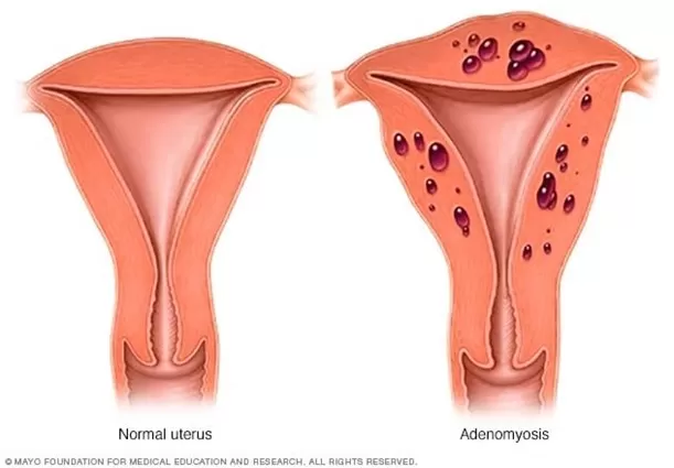 adenomyozis